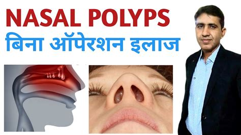 Swollen Nasal Polyps