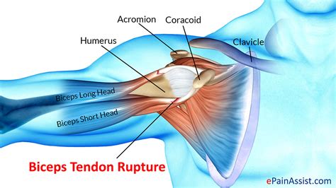 Biceps Tendon Rupture: Treatment, Exercise, Types, Causes