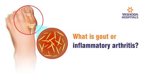 Gout and Inflammatory Arthritis Treatment Hospital in Hyderabad