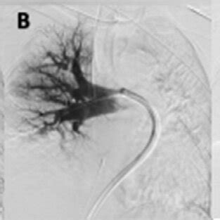 (PDF) A report of 2 cases of the use of the Inari FlowTriever System in ...