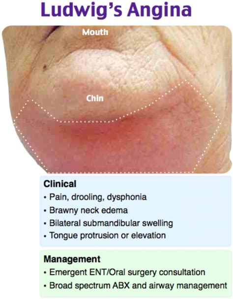 emDOCs.net – Emergency Medicine EducationEM@3AM: Ludwig's Angina - emDOCs.net - Emergency ...