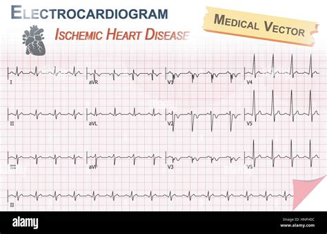 Ecg Anatomy