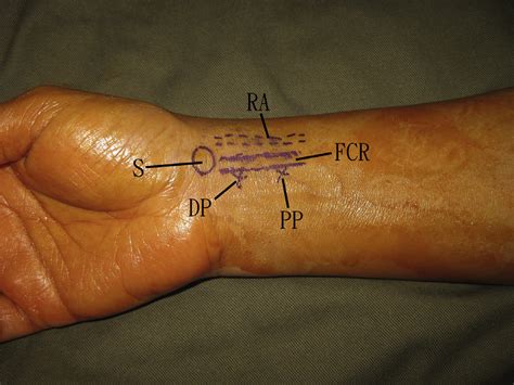 Wrist Artery Anatomy