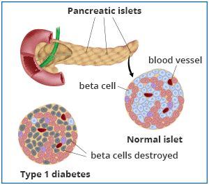 Pancreatic Islet Transplantation | NIDDK