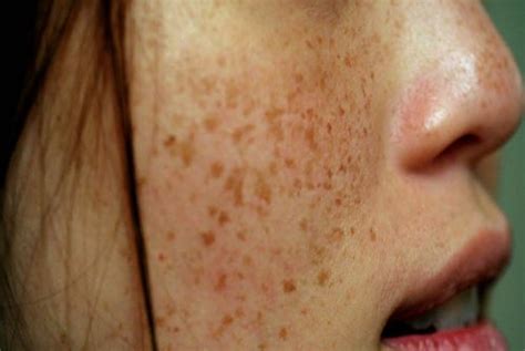 What-causes-dark-spots - Estetica