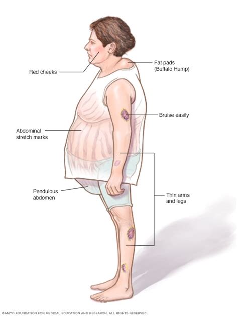 Cushing syndrome - Symptoms and causes - Mayo Clinic