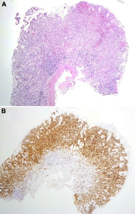 Mucosal biopsy findings. (A) Biopsy of the gastric antrum shows diffuse ...