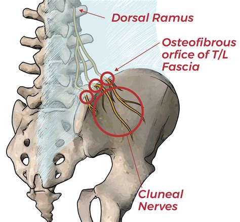 Essential Skills To Resolve Cluneal Neuropathy — ChiroUp