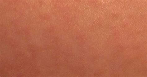 Another Day...: Keratosis Pilaris - update after 4 days of treatment ...