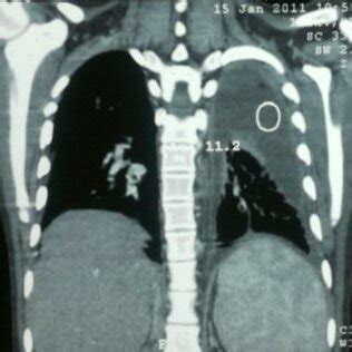 CT thorax showing left empyema-thoracis. | Download Scientific Diagram