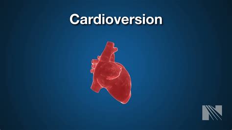 Cardioversion Procedure: Returning a heartbeat to normal rythm - YouTube