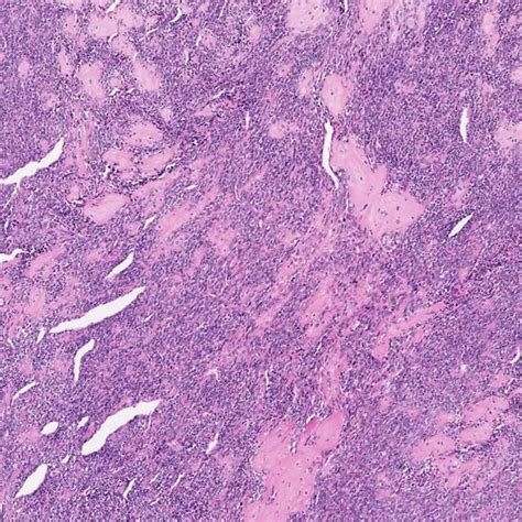 Typical hemangiopericytoma-like vascular pattern (H&E, high power view). | Download Scientific ...