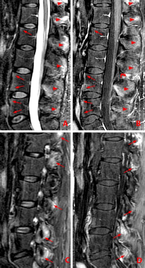 Ankylosing Spondylitis Mri