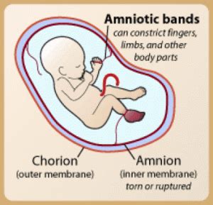 Amniotic Band Diagnosis and Treatment