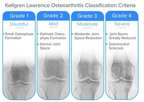 Does Tricompartmental Osteoarthritis Necessitate Surgical Intervention?