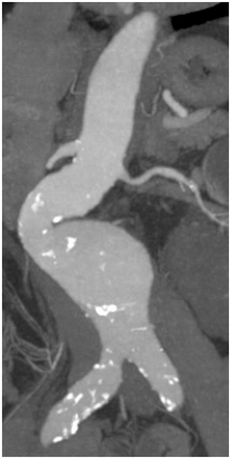 | (A) CT axial image of an infrarenal AAA with intraluminal thrombus.... | Download Scientific ...