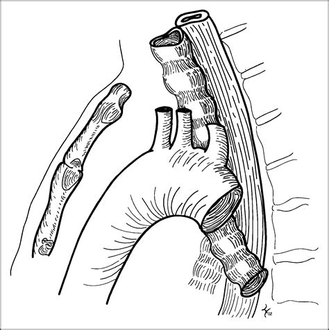 Aortic suspension (aortopexy) for severe tracheomalacia in infants and children - The American ...