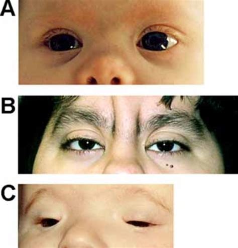 Cantú syndrome: MedlinePlus Genetics