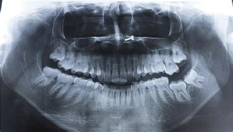 Pterygoid Plate Radiograph