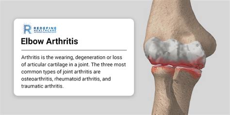 Elbow Arthritis - NJ's Top Orthopedic Spine & Pain Management Center