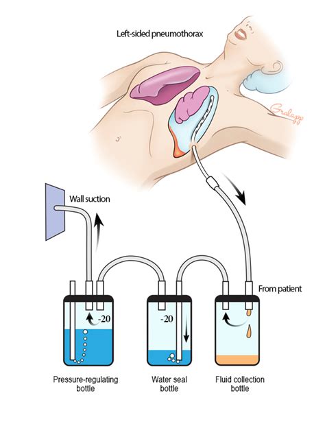 Chest Tube Complications | PSNet | Nursing school survival, Emergency ...