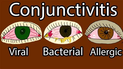 Pink Eye (Conjunctivitis) - Viral, Bacterial and allergic conjunctivitis. Symptoms and treatment ...