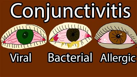 Allergic Conjunctivitis Discharge