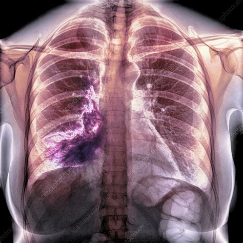 Pneumonia, X-ray - Stock Image - C050/9718 - Science Photo Library