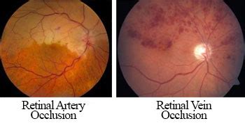 What is Retinal Artery and Vein Occlusion and What Causes It? - EyeSight