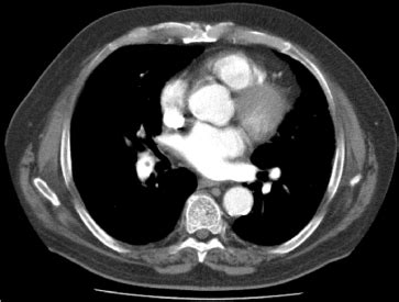 Pulmonary embolism (acute or chronic)