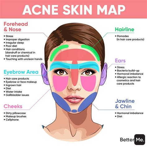 Acne Face Mapping What Does Your Acne Tell You Acne Face Map Female ...