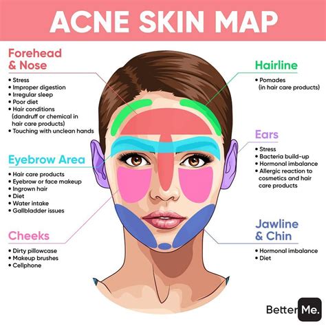 Pro.Skin Laser & Aesthetics on Instagram: “THIS IS WHAT ACNE SAYS ABOUT YOUR HEALTH👆🏻👁 Where do ...