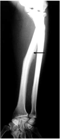 X-ray forearm showing interosseous membrane calcification. | Download Scientific Diagram