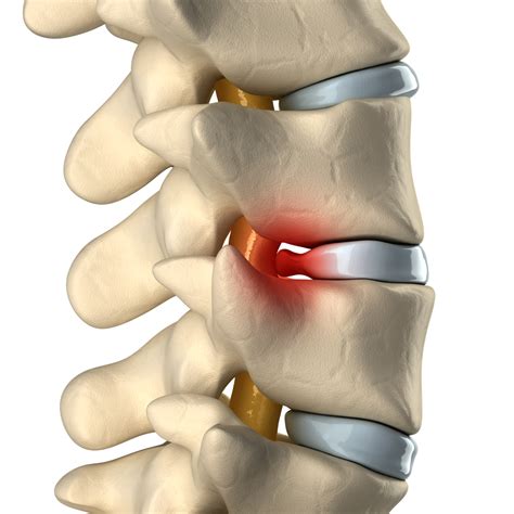 Slipped Disc - Causes, Symptoms & Treatment | Bonati Spine Institute