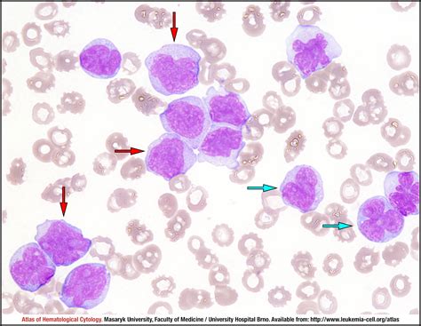 Acute monoblastic/monocytic leukaemia - CELL - Atlas of Haematological Cytology