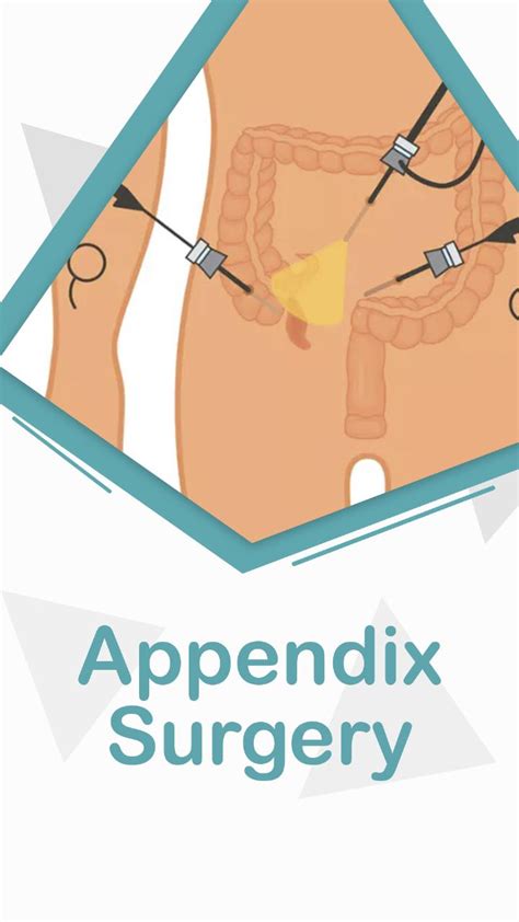 Appendix Surgery 101: Types, Symptoms, Recovery, and Cost