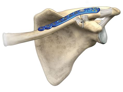 Clavicle Plating System | Acumed