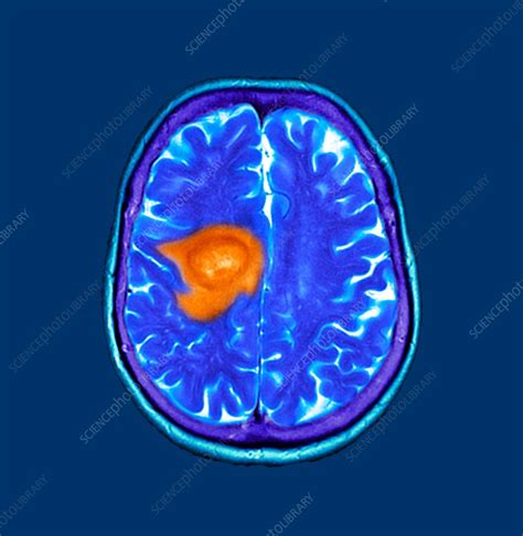 Brain cancer, CT scan - Stock Image - F023/8537 - Science Photo Library