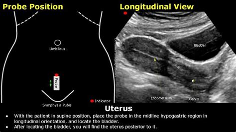 Uterus & Ovaries Ultrasound Probe Positioning | Transducer Placement | Gynecological USG ...