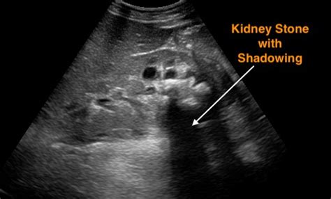 Kidney Stone Ultrasound