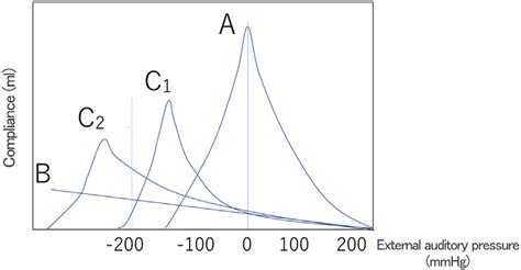Tympanogram. Tympanogram of type A in a normal ear, as the pressure in... | Download Scientific ...