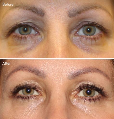 Laser Treatments for Dark Circles: Are They Worth It, Before & Afters, Cost