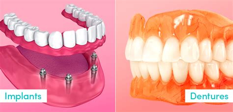 Dentures vs. Dental Implants – Dentistry.com