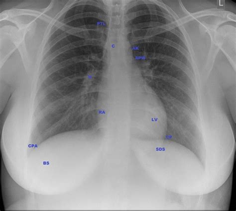 Normal Chest X Ray Labeled