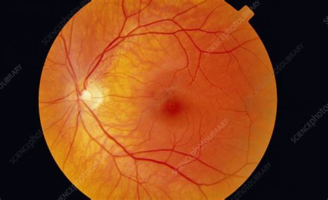 Healthy retina - Stock Image - P424/0175 - Science Photo Library