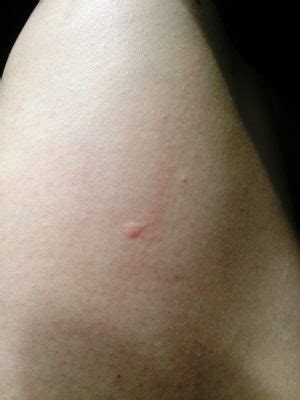 Mosquito Bite Blisters: Causes and Treatment - PestSeek