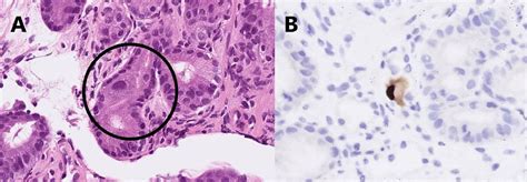 Cytomegalovirus gastritis: Clinicopathological profile - Digestive and ...