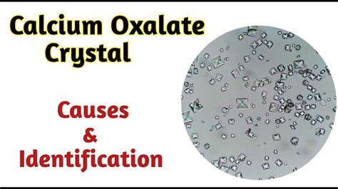 calcium oxalate crystals in urine | calcium oxalate in urine causes ...