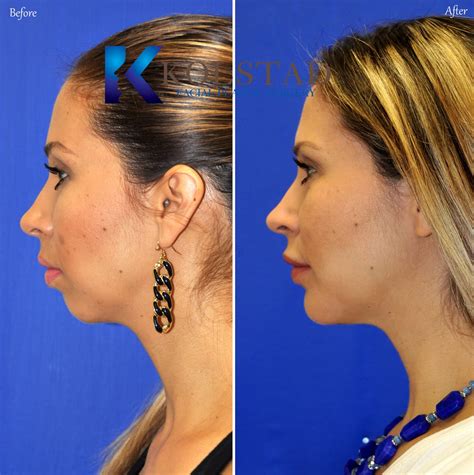 chin augmentation san diego 306 copy | Dr. Kolstad - San Diego Facial Plastic Surgeon