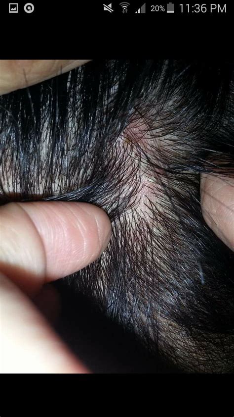 [Acne] scalp acne or scalp folliculitis? : SkincareAddiction